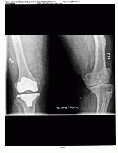X-ray image of both knees