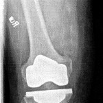 X-ray image of Lynn's resurfaced right knee.