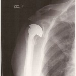 This is an x-ray image showing the steel implant that takes the place of my original equipment humerus.