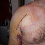 The surgical entry wound for my hemi-arthroplasty